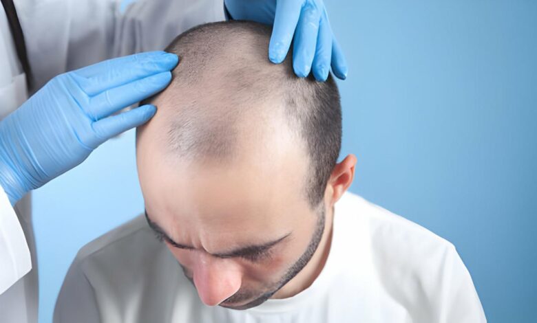 Transforming Tresses in the Heart of London: Your Hair Transplant Guide