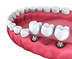 How Do At-Home Dentures Work?